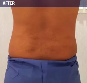 After body contouring result photo in Centennial, CO
