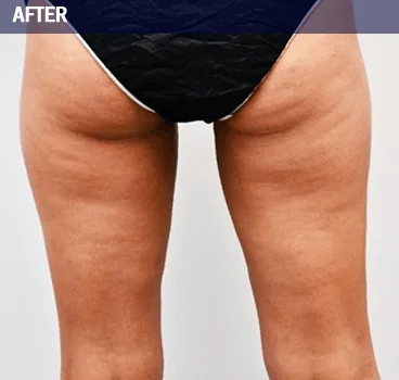 After body contouring result photo in Centennial, CO
