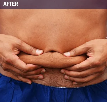 After body contouring result photo in Centennial, CO