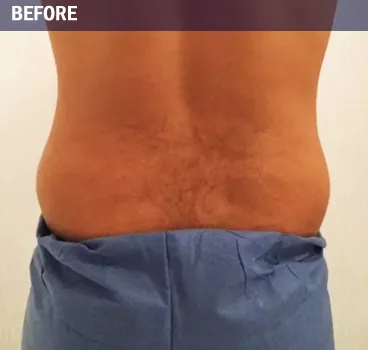 Before body contouring result photo in Centennial, CO