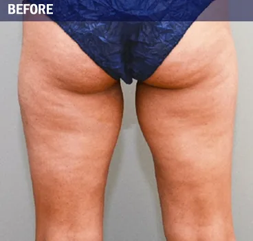Before body contouring result photo in Centennial, CO