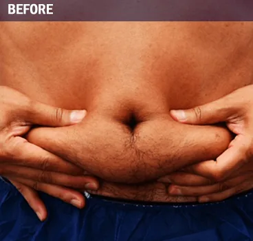 Before body contouring result photo in Centennial, CO